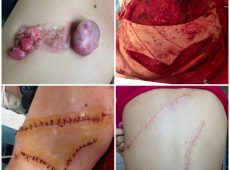 Злокачественная фиброзная гистиоцитома