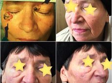 базальноклкточный рак