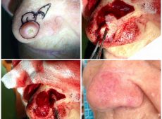 базалиома кончика носа