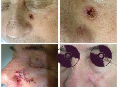 плоскоклеточный рак кожи