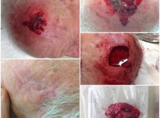 рак кожи волосистой части